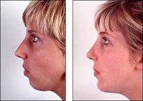 chin augmentation prices