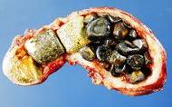 flushing gallstones