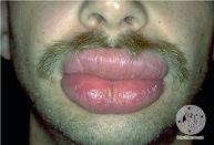 how to treat a swollen lips