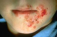 how to treat impetigo