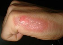 how to treat mild burn