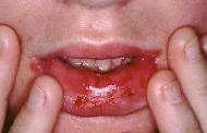 how to treat mouth ulcers