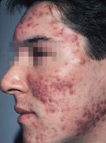 how to treat nodular acne
