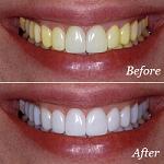 top over the counter whitening toothpaste