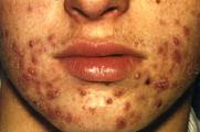 Cure Hormonal Acne Naturally