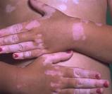 How to Cure Vitiligo Naturally
