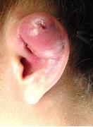 How to Treat Infected Ear Piercing