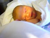 Treat Jaundice in Newborns