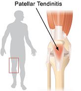 patellar tendonitis or jumpers knee