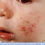 Baby Rashes on Face picture 2