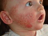 Baby Rashes on Face picture