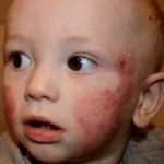 Baby's Rashes on Face photo 3