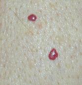 Cherry Angiomas Home Remedies