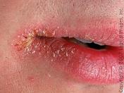 How to Get Rid of Chapped Lips Fast
