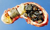 How to Know if You Have Gallstones
