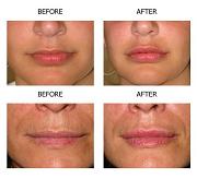 Permanent Lip Augmentation - Before and After Photos & Cost