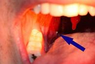 Cure Tonsil Stones Naturally