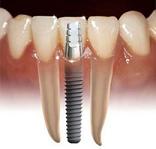 Dental Implants Cost - Manila Philippines