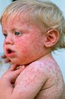 German Measles Symptoms and Treatment