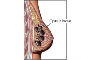 How to Prevent Breast Cysts