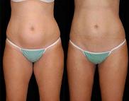 Laser Liposuction Side Effects