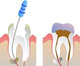 Root Canal Cost in Philippines
