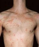 Treat Rashes on Body