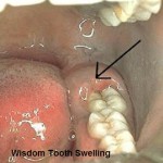 Wisdom Tooth Swelling