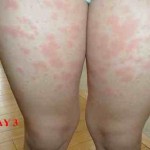 hiv rash picture