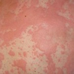 hiv skin rash close up image