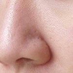 large pores on face