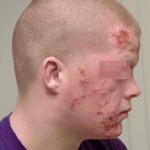 photo of hiv rashes on face