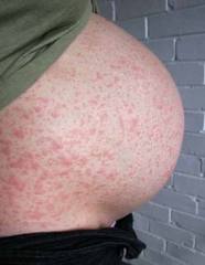 rashes during pregnancy