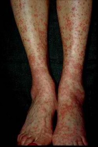 treat vasculitis