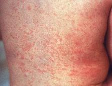 Rubella Measles Signs & Symptoms