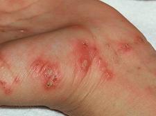 Scabies Causes, Signs & Symptoms, Treatment, and Prevention