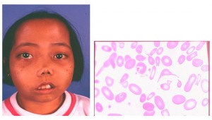 Thalassemia Symptoms and Treatment