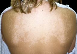 how to get rid of white spots on skin